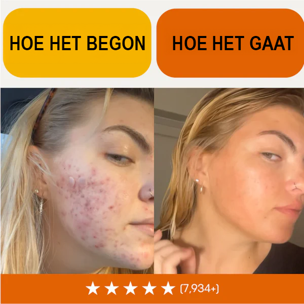 Essentiële acne eliminatie kit